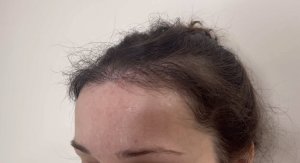 Повторная пересадка: уплотнение передней линии роста волос.