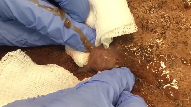 Big Cyst Pop! Camera Girl Gets Sprayed by Gross Cyst смотреть онлайн
