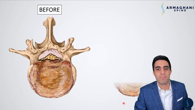 Step by step how to perform a lumbar laminectomy смотреть онлайн
