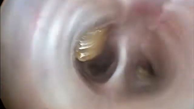 Pus in the bronchi(плотный гной в бронхах) смотреть онлайн