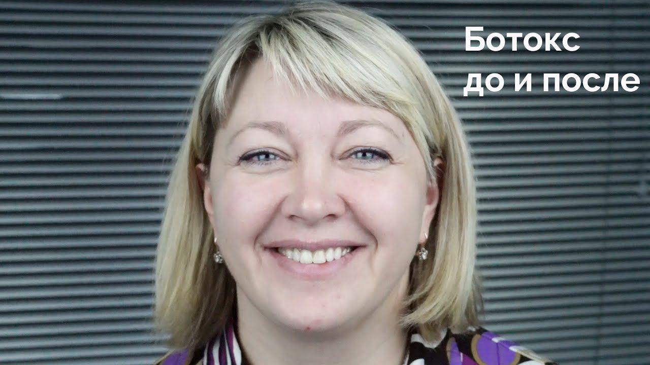До и после | ботокс между бровей и лоб | ксеомин, диспорт, ботекс | косметология самара смотреть онлайн