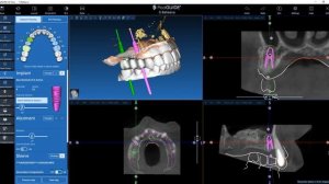 Моделируем хирургический навигационный шаблон в RealGuide