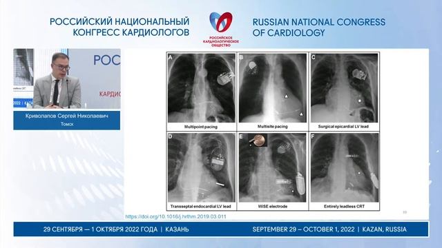 Нерешенные вопросы сердечной ресинхронизирующей терапии смотреть онлайн