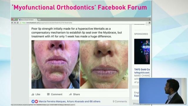 Рохан Виджей о миофункциональном подходе к лечению прикуса смотреть онлайн