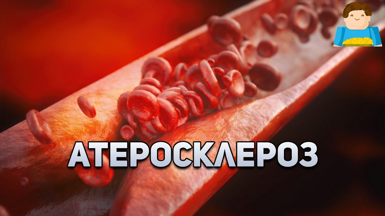 Что является причиной сердечного приступа? | Plushkin смотреть онлайн