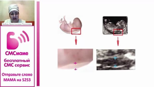 Скрининг 1-го триместра беременности смотреть онлайн