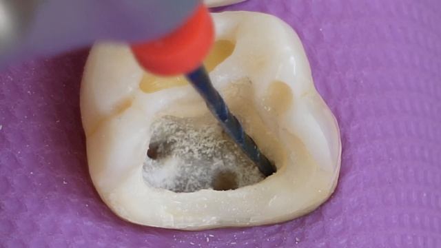 FANTASTIC Restoration Of Tooth Cavity By Root Canal And Composite Filling.