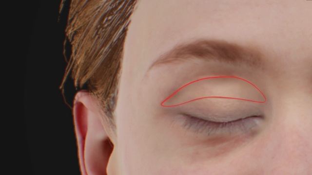 Droopy Eyelid (Ptosis) Repair
