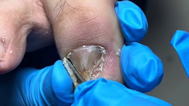 Remove thick nails layer by layer, Super long onychomycosis【Pedicure Master Lin Jun】 смотреть онлайн