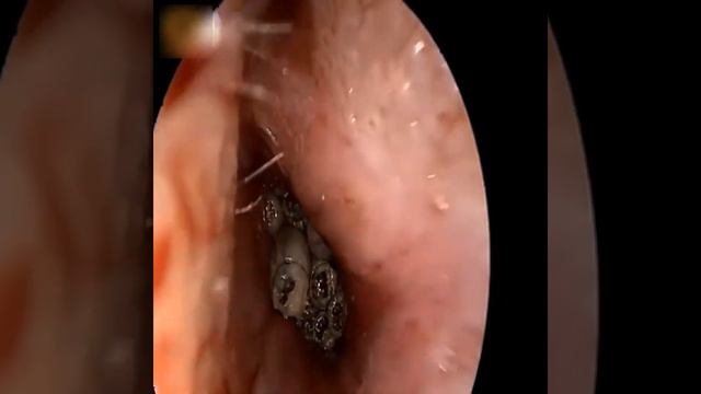 Паразиты в носу ребенка. Вытащить червя из носа