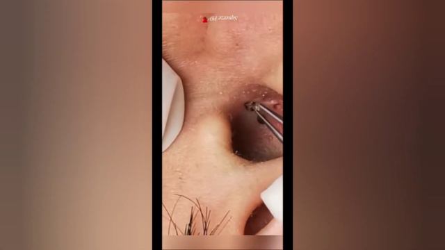 Pimple/Прыщи на носу /давим прыщ #pimplefreeskin #pimple