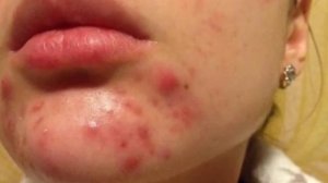 МАЗЬ ВИШНЕВСКОГО.  ДОСТАНЕТ ГНОЙ ЛЮБОЙ ЦЕНОЙ. НАРЫВ. ЧИРЯК. ФУРУНКУЛ