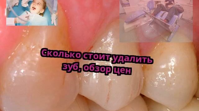 Сколько стоит удалить зуб, обзор цен смотреть онлайн