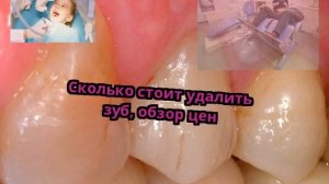 Сколько стоит удалить зуб, обзор цен