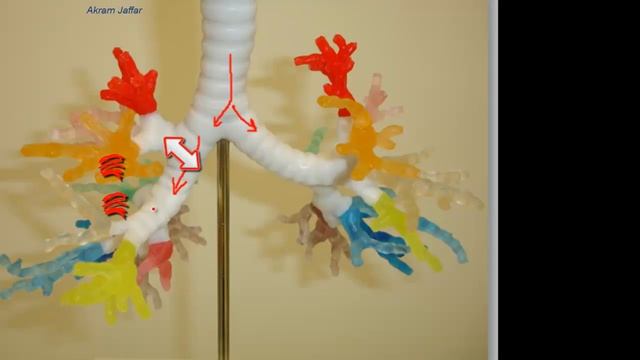 Right or left: where would an inhaled foreign body go? смотреть онлайн