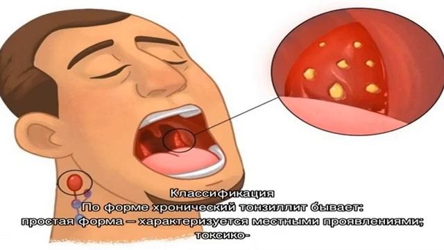 Чем отличается тонзиллит от ангины смотреть онлайн