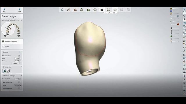 Error with implant it should be only one boundary on temp model how to fix this with 3shape смотреть онлайн