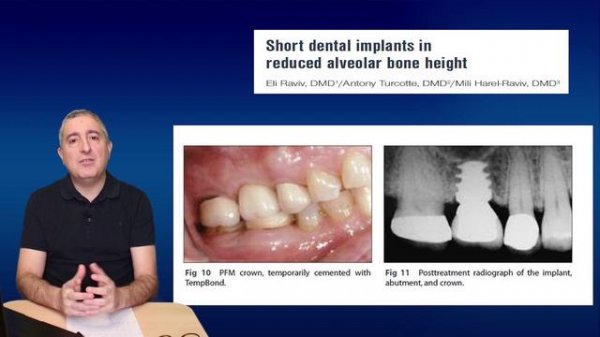Короткие импланты: кому, зачем и когда (Длина импланта)