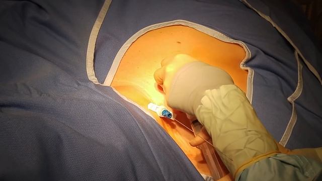 Subcutaneous Port Placement смотреть онлайн