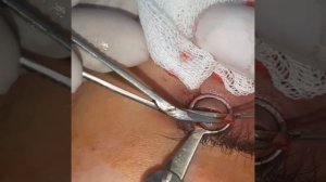 🇷🇺 Удаление халязион 🇦🇲Խալազիոնի հեռացում 🇺🇲Chalazion removal