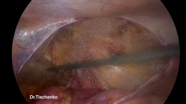 TAPP repair of a direct hernia. Лечение паховых грыж. смотреть онлайн