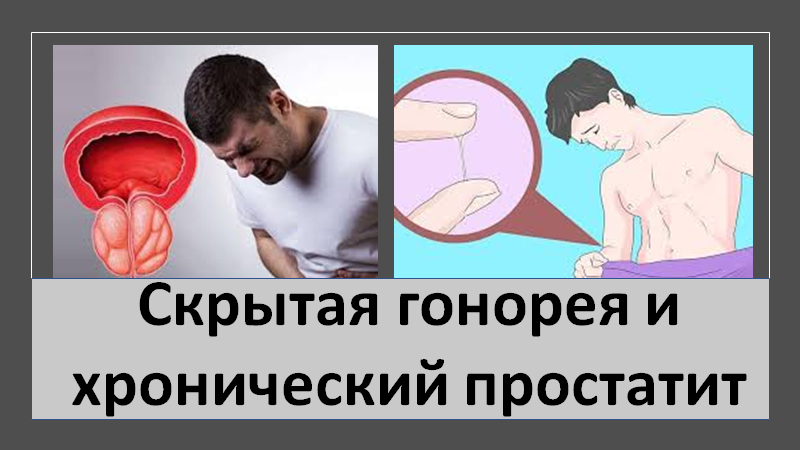Скрытая гонорея и хронический простатит смотреть онлайн
