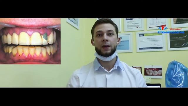 crowns zirconia , veneers , crowns CEREC. Dissection of teeth for all-ceramic смотреть онлайн