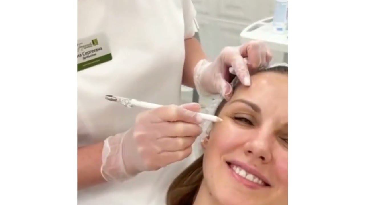 Коррекция морщин Fullface - ботулотоксином смотреть онлайн