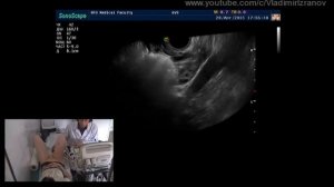 Практическое занятие: УЗИ органов малого таза.  Пациентка 4