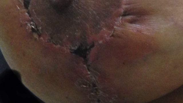 Gummy bear Breast implants horror of Adam Rubinstein Breast butcher of Miami смотреть онлайн
