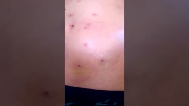 Шрамы после пиявок