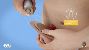 Разъяснения по смене мешка стомы (EAU - SBR RU)