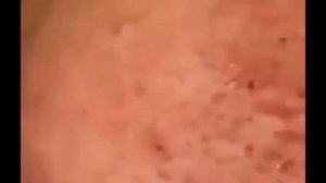 удаление прыщей №23 Unbelievable Transformation: Watch THIS to See How to Get Rid of Acne!