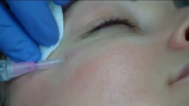 Биоревитализация лица смотреть онлайн