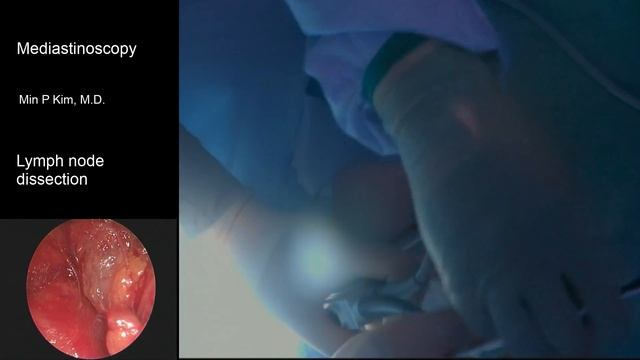 How to perform a mediastinoscopy? смотреть онлайн