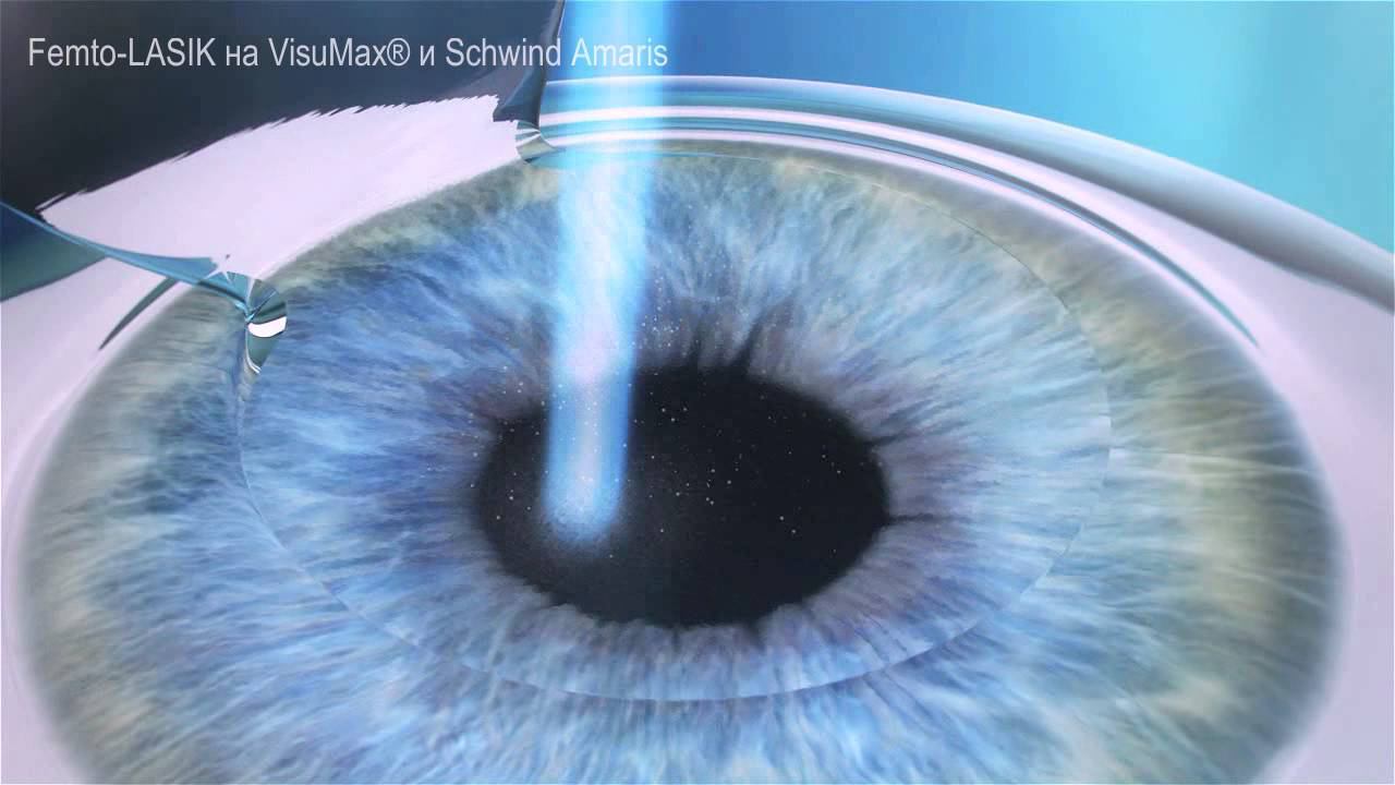 FEMTO LASIK смотреть онлайн