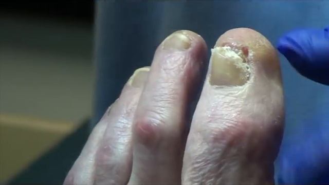 Are Ingrown Toenails Painful? Preventing Ingrown Nails With Dr Nail Nipper (2019)
