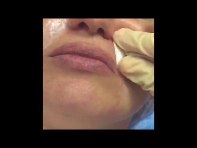 КОРРЕКЦИЯ НОСОГУБНЫХ СКЛАДОК смотреть онлайн