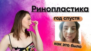 Ринопластика. Что стало с моим носом спустя год