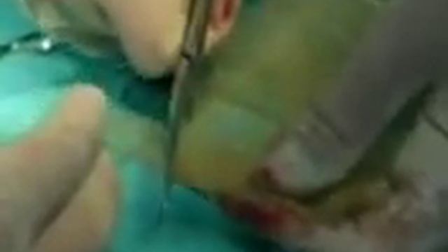 orbital FLOOR FRACTURE mpeg4 смотреть онлайн