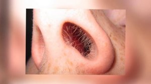 ПОЧЕМУ ОПАСНО ВЫЩИПЫВАТЬ ВОЛОСЫ В НОСУ?!