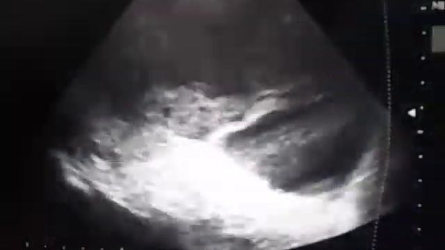 Огромный плевральный выпот смотреть онлайн