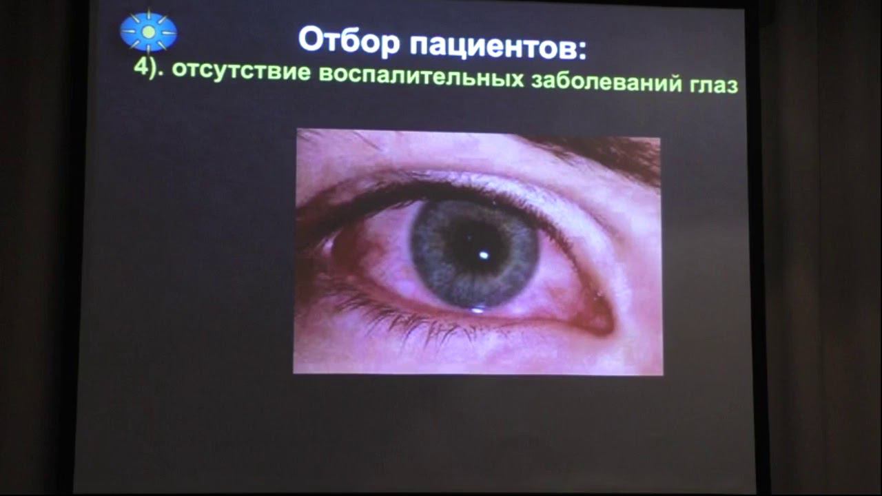 Лазерный витреолизис плавающих помутнений стекловидного тела. смотреть онлайн