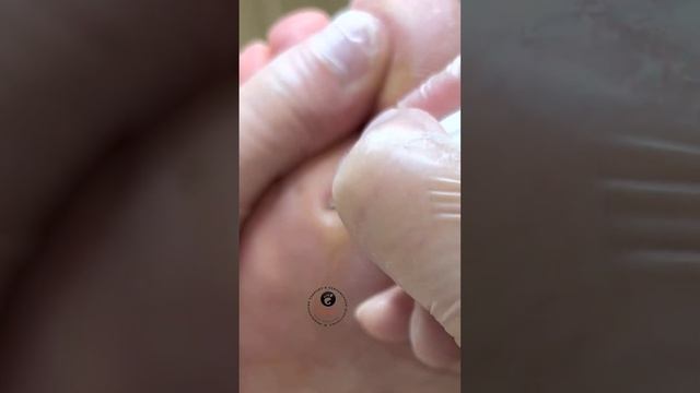 ?Техника обработки твёрдых мозолей смотреть онлайн