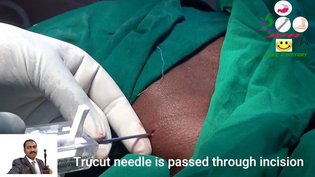 Trucut needle biopsy/Core needle biopsy/Non hodgkin lymphoma/Lymph node biopsy neck /Dr. Pandiaraja смотреть онлайн