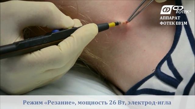 Радиоволновое удаление невуса смотреть онлайн