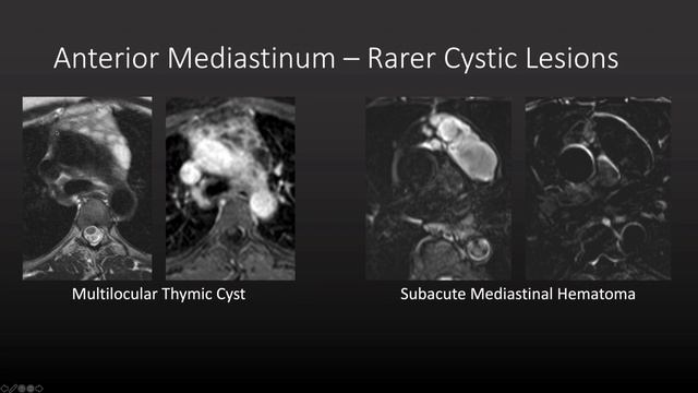 Approach to Mediastinal Masses смотреть онлайн
