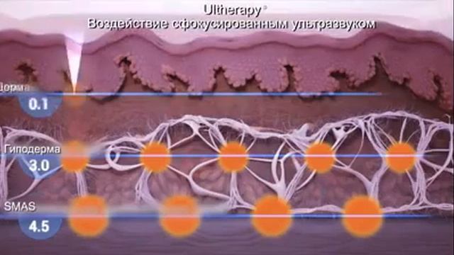 СМАС лифтинг Альтера смотреть онлайн