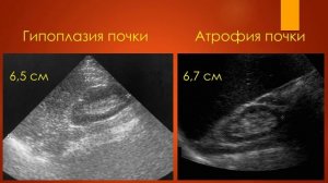 УЛЬТРАЗВУК В РУКАХ УРОЛОГА. УЗИ ПОЧЕК. Нормальная анатомия и аномалии развития