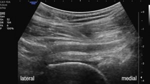 Блокада седалищного нерва под УЗ-навигацией (Subgluteal Sciatic Nerve Block)